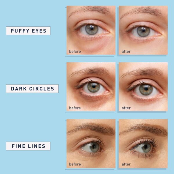 Enaskin Naturals Under Eye Patches for Dark Circles: 30 Pair...