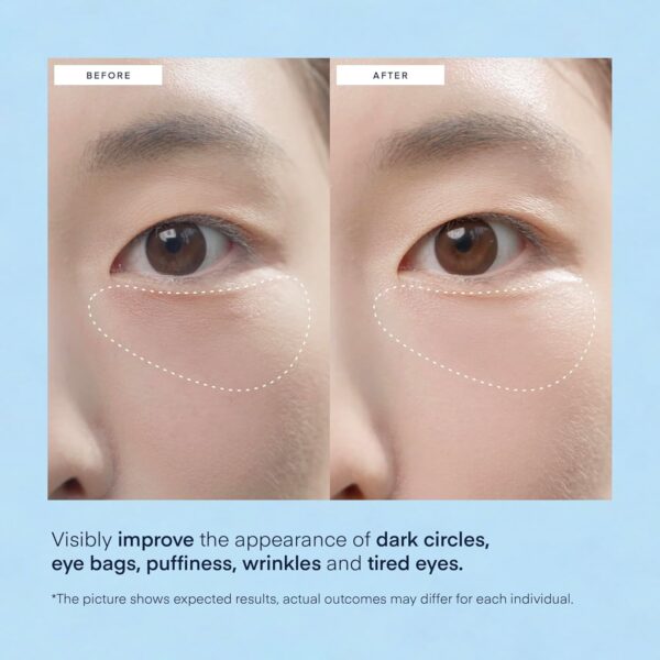 Under Eye Patches for Dark Circles: Puffiness & Eye Bag Trea...