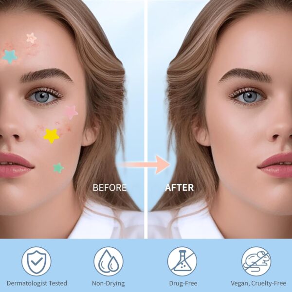 Pimple Patches for Face, Hydrocolloid Acne Patches, Cute Sta...