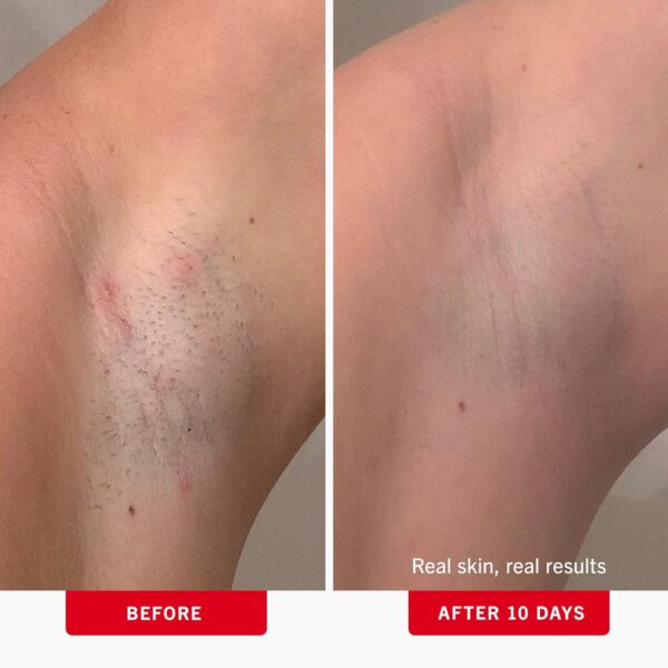 First Aid Beauty - Ingrown Hair Pads with BHA + AHA - Afters...