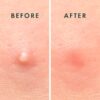 Rael Pimple Patches, Miracle Invisible Spot Cover - Hydrocol...