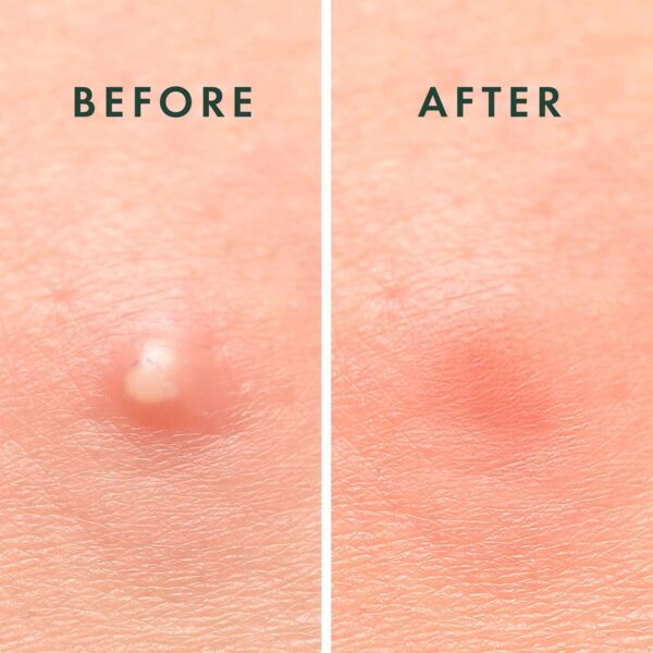 Rael Pimple Patches, Miracle Invisible Spot Cover - Hydrocol...