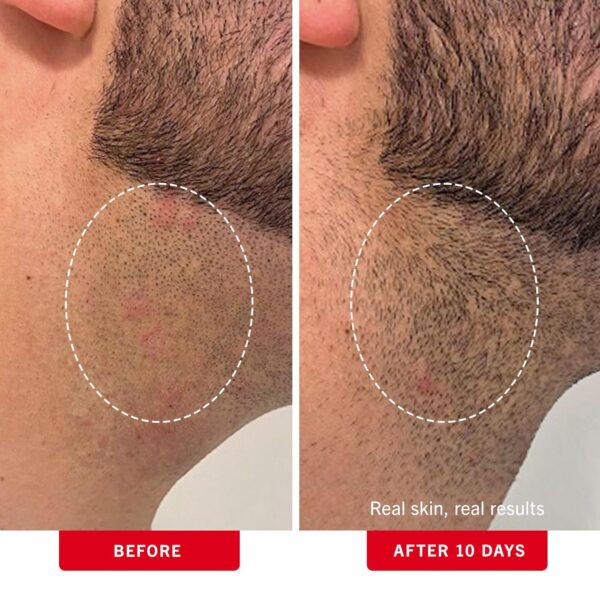 First Aid Beauty - Ingrown Hair Pads with BHA + AHA - Afters...